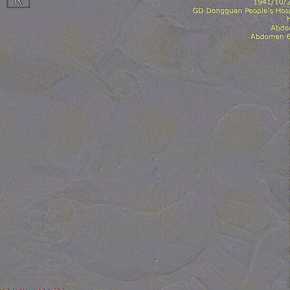 gore医疗怎么样「胸有乾坤」危如累卵 妙手回春——Conformable GORE®TAG®胸主动脉覆膜支架应用于高龄急性主动脉夹层治疗_https://www.jmylbn.com_新闻资讯_第22张