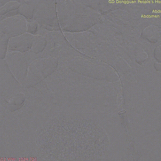 gore医疗怎么样「胸有乾坤」危如累卵 妙手回春——Conformable GORE®TAG®胸主动脉覆膜支架应用于高龄急性主动脉夹层治疗_https://www.jmylbn.com_新闻资讯_第35张