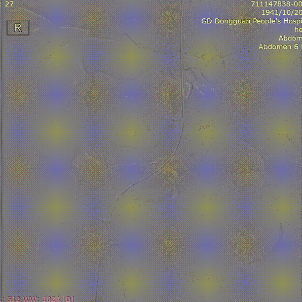 gore医疗怎么样「胸有乾坤」危如累卵 妙手回春——Conformable GORE®TAG®胸主动脉覆膜支架应用于高龄急性主动脉夹层治疗_https://www.jmylbn.com_新闻资讯_第38张