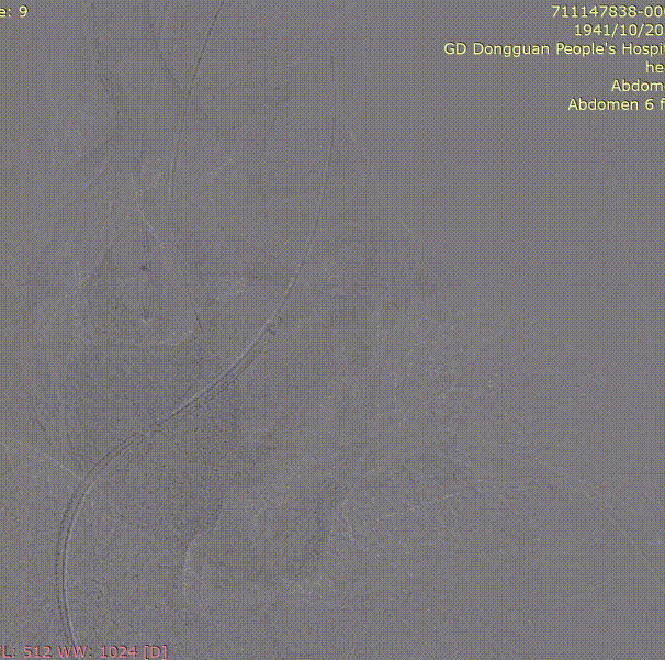 gore医疗怎么样「胸有乾坤」危如累卵 妙手回春——Conformable GORE®TAG®胸主动脉覆膜支架应用于高龄急性主动脉夹层治疗_https://www.jmylbn.com_新闻资讯_第26张