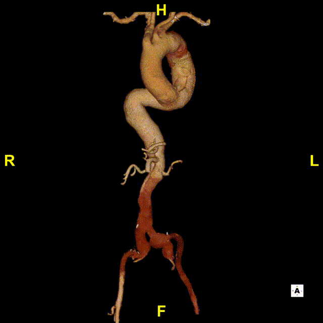 gore医疗怎么样「胸有乾坤」危如累卵 妙手回春——Conformable GORE®TAG®胸主动脉覆膜支架应用于高龄急性主动脉夹层治疗_https://www.jmylbn.com_新闻资讯_第8张