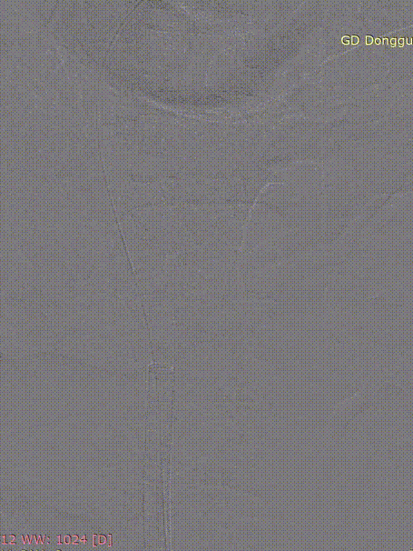 gore医疗怎么样「胸有乾坤」危如累卵 妙手回春——Conformable GORE®TAG®胸主动脉覆膜支架应用于高龄急性主动脉夹层治疗_https://www.jmylbn.com_新闻资讯_第25张