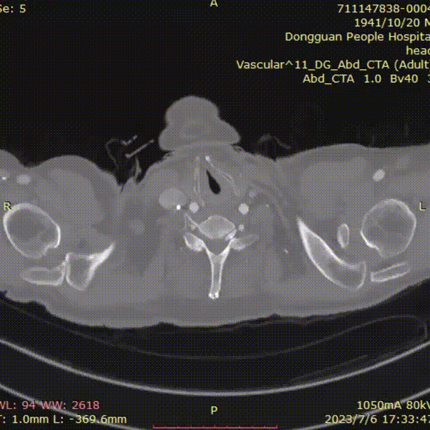 gore医疗怎么样「胸有乾坤」危如累卵 妙手回春——Conformable GORE®TAG®胸主动脉覆膜支架应用于高龄急性主动脉夹层治疗_https://www.jmylbn.com_新闻资讯_第41张