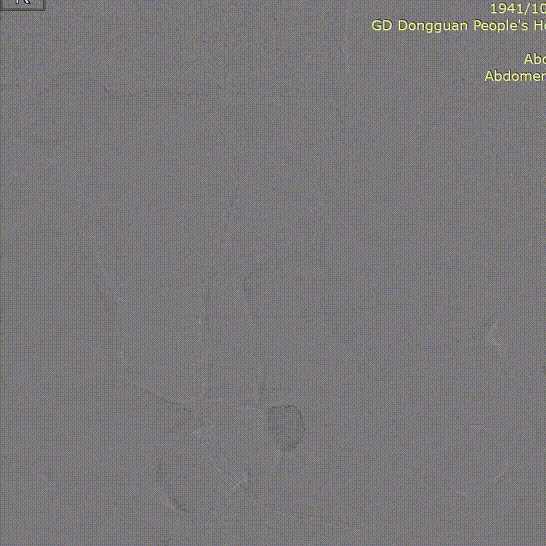 gore医疗怎么样「胸有乾坤」危如累卵 妙手回春——Conformable GORE®TAG®胸主动脉覆膜支架应用于高龄急性主动脉夹层治疗_https://www.jmylbn.com_新闻资讯_第21张