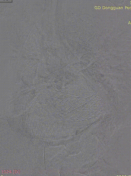 gore医疗怎么样「胸有乾坤」危如累卵 妙手回春——Conformable GORE®TAG®胸主动脉覆膜支架应用于高龄急性主动脉夹层治疗_https://www.jmylbn.com_新闻资讯_第32张