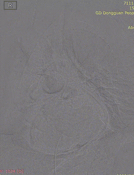 gore医疗怎么样「胸有乾坤」危如累卵 妙手回春——Conformable GORE®TAG®胸主动脉覆膜支架应用于高龄急性主动脉夹层治疗_https://www.jmylbn.com_新闻资讯_第23张