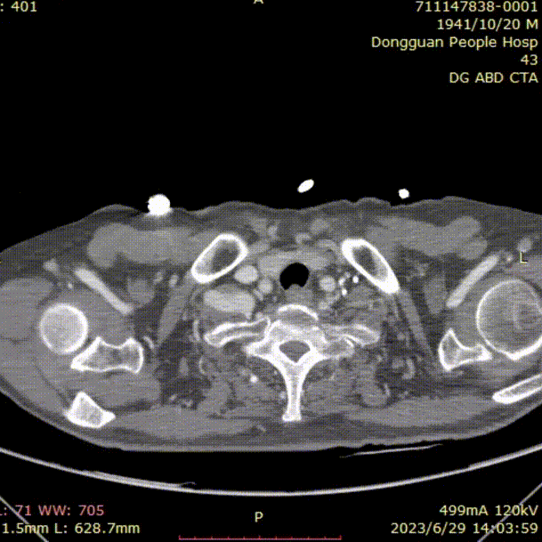 gore医疗怎么样「胸有乾坤」危如累卵 妙手回春——Conformable GORE®TAG®胸主动脉覆膜支架应用于高龄急性主动脉夹层治疗_https://www.jmylbn.com_新闻资讯_第7张