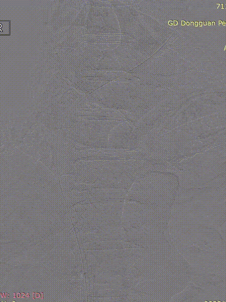 gore医疗怎么样「胸有乾坤」危如累卵 妙手回春——Conformable GORE®TAG®胸主动脉覆膜支架应用于高龄急性主动脉夹层治疗_https://www.jmylbn.com_新闻资讯_第24张