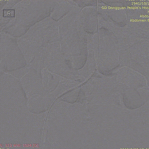 gore医疗怎么样「胸有乾坤」危如累卵 妙手回春——Conformable GORE®TAG®胸主动脉覆膜支架应用于高龄急性主动脉夹层治疗_https://www.jmylbn.com_新闻资讯_第39张