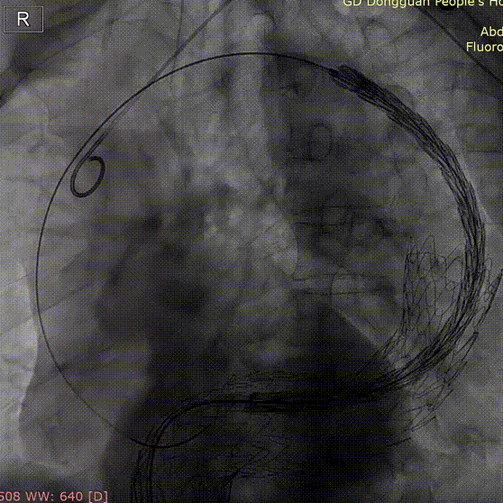 gore医疗怎么样「胸有乾坤」危如累卵 妙手回春——Conformable GORE®TAG®胸主动脉覆膜支架应用于高龄急性主动脉夹层治疗_https://www.jmylbn.com_新闻资讯_第29张