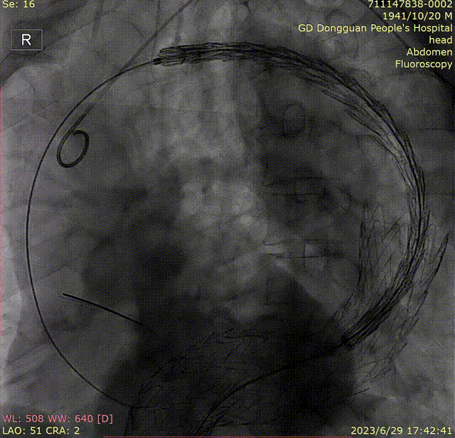 gore医疗怎么样「胸有乾坤」危如累卵 妙手回春——Conformable GORE®TAG®胸主动脉覆膜支架应用于高龄急性主动脉夹层治疗_https://www.jmylbn.com_新闻资讯_第31张