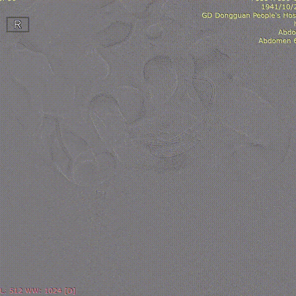 gore医疗怎么样「胸有乾坤」危如累卵 妙手回春——Conformable GORE®TAG®胸主动脉覆膜支架应用于高龄急性主动脉夹层治疗_https://www.jmylbn.com_新闻资讯_第40张