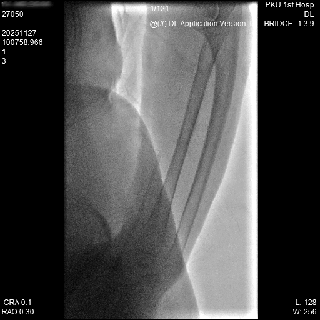 动脉长鞘怎么置入桡胜一筹丨杨敏教授团队：应用Brite Tip Radianz长鞘经远桡动脉治疗肾动脉狭窄一例_https://www.jmylbn.com_新闻资讯_第19张