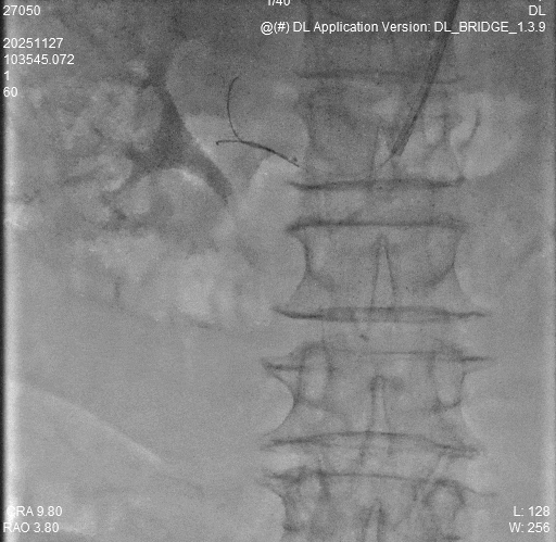 动脉长鞘怎么置入桡胜一筹丨杨敏教授团队：应用Brite Tip Radianz长鞘经远桡动脉治疗肾动脉狭窄一例_https://www.jmylbn.com_新闻资讯_第22张