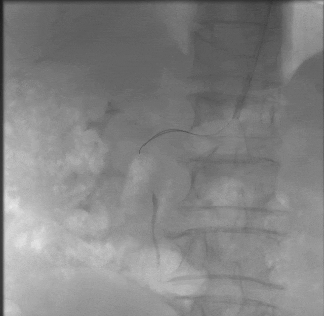 动脉长鞘怎么置入桡胜一筹丨杨敏教授团队：应用Brite Tip Radianz长鞘经远桡动脉治疗肾动脉狭窄一例_https://www.jmylbn.com_新闻资讯_第21张