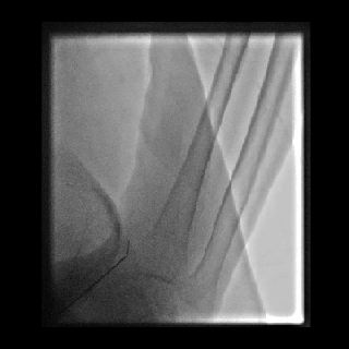 动脉长鞘怎么置入桡胜一筹丨杨敏教授团队：应用Brite Tip Radianz长鞘经远桡动脉治疗肾动脉狭窄一例_https://www.jmylbn.com_新闻资讯_第18张