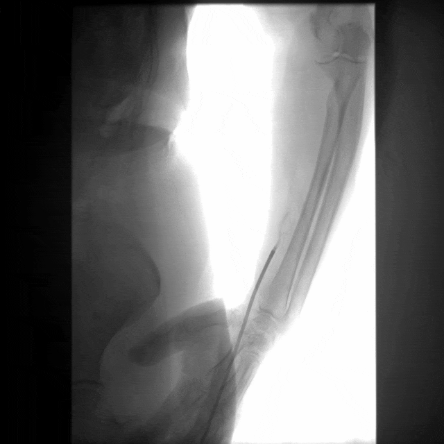 动脉长鞘怎么置入桡胜一筹丨杨敏教授团队：应用Brite Tip Radianz长鞘经远桡动脉治疗肾动脉狭窄一例_https://www.jmylbn.com_新闻资讯_第29张