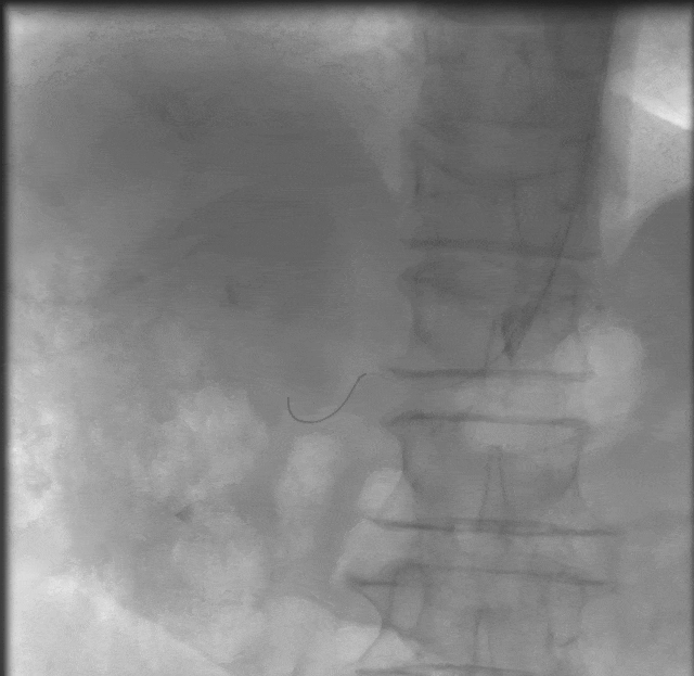 动脉长鞘怎么置入桡胜一筹丨杨敏教授团队：应用Brite Tip Radianz长鞘经远桡动脉治疗肾动脉狭窄一例_https://www.jmylbn.com_新闻资讯_第24张