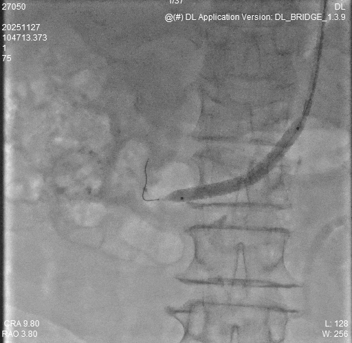 动脉长鞘怎么置入桡胜一筹丨杨敏教授团队：应用Brite Tip Radianz长鞘经远桡动脉治疗肾动脉狭窄一例_https://www.jmylbn.com_新闻资讯_第23张