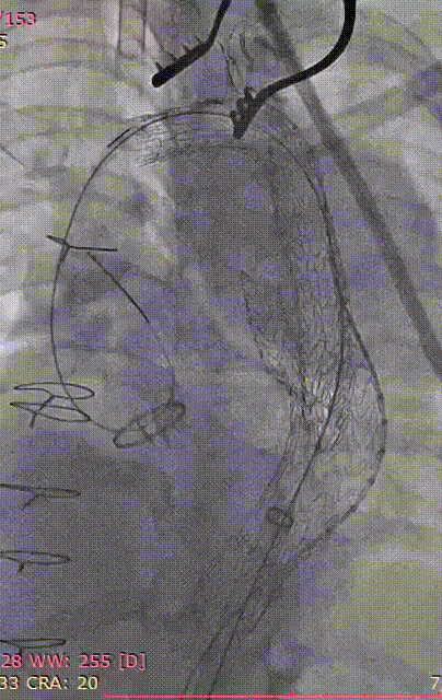 gore医疗怎么样「胸有乾坤」可调可控 精准出击——四川大学华西医院肖正华教授团队：CADS治疗B型主动脉夹层病例分享_https://www.jmylbn.com_新闻资讯_第26张