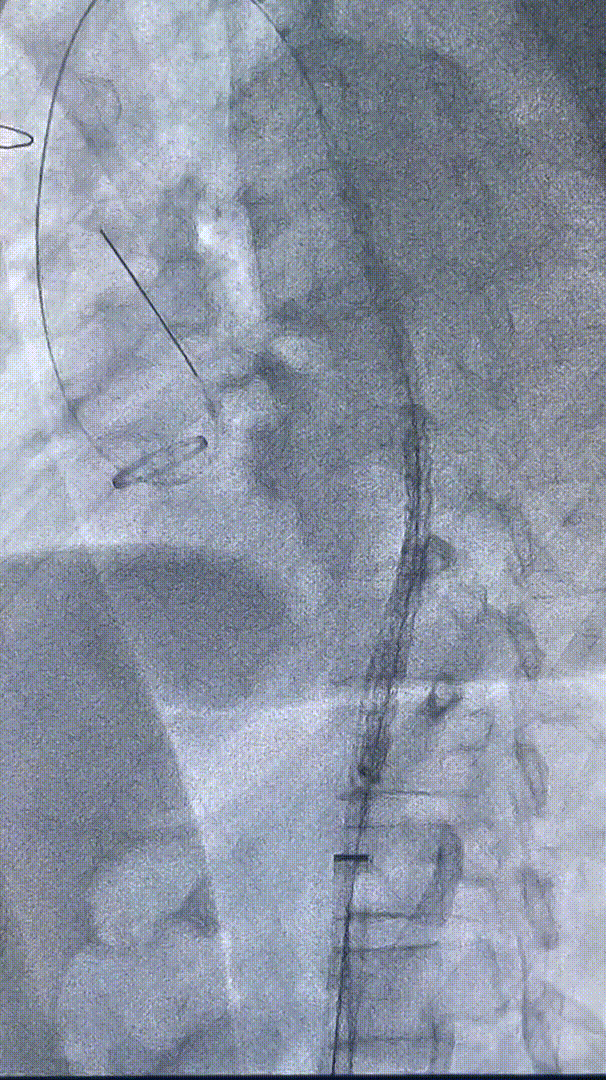 gore医疗怎么样「胸有乾坤」可调可控 精准出击——四川大学华西医院肖正华教授团队：CADS治疗B型主动脉夹层病例分享_https://www.jmylbn.com_新闻资讯_第21张