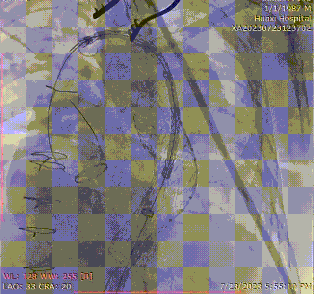 gore医疗怎么样「胸有乾坤」可调可控 精准出击——四川大学华西医院肖正华教授团队：CADS治疗B型主动脉夹层病例分享_https://www.jmylbn.com_新闻资讯_第24张