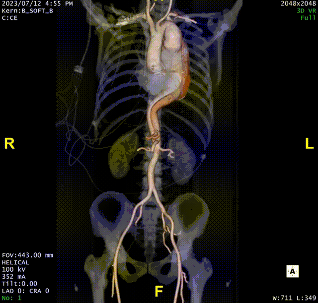 gore医疗怎么样「胸有乾坤」可调可控 精准出击——四川大学华西医院肖正华教授团队：CADS治疗B型主动脉夹层病例分享_https://www.jmylbn.com_新闻资讯_第8张