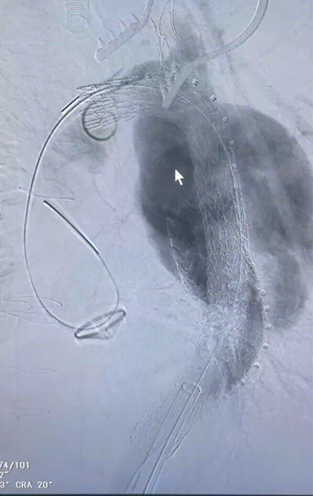 gore医疗怎么样「胸有乾坤」可调可控 精准出击——四川大学华西医院肖正华教授团队：CADS治疗B型主动脉夹层病例分享_https://www.jmylbn.com_新闻资讯_第25张