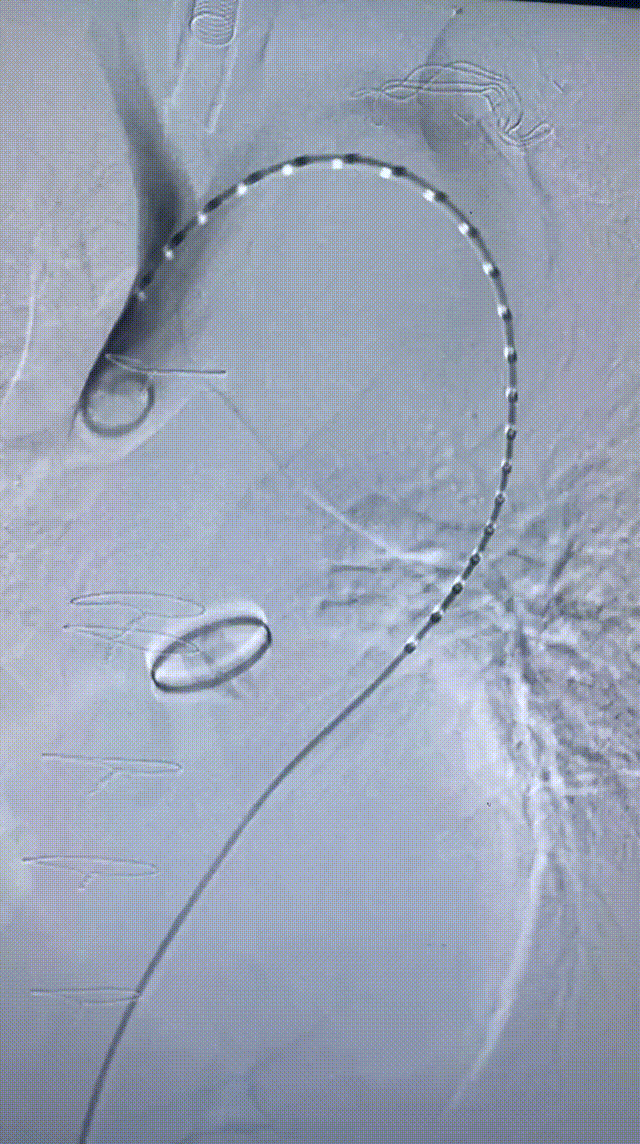 gore医疗怎么样「胸有乾坤」可调可控 精准出击——四川大学华西医院肖正华教授团队：CADS治疗B型主动脉夹层病例分享_https://www.jmylbn.com_新闻资讯_第19张