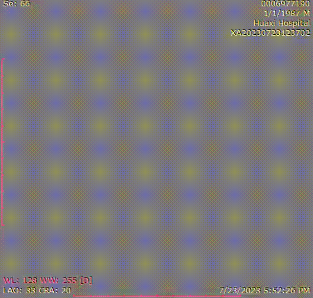 gore医疗怎么样「胸有乾坤」可调可控 精准出击——四川大学华西医院肖正华教授团队：CADS治疗B型主动脉夹层病例分享_https://www.jmylbn.com_新闻资讯_第22张