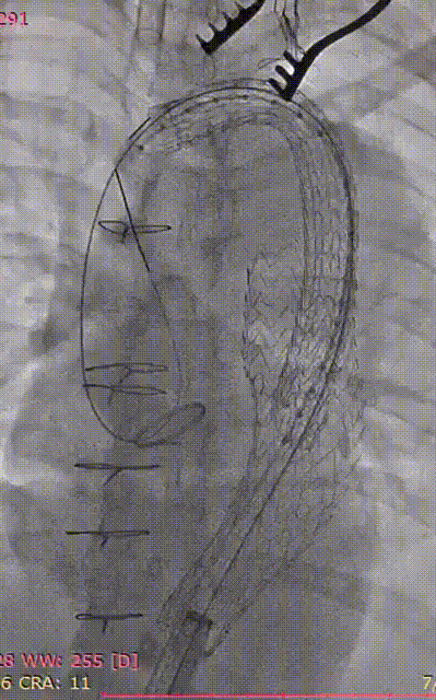 gore医疗怎么样「胸有乾坤」可调可控 精准出击——四川大学华西医院肖正华教授团队：CADS治疗B型主动脉夹层病例分享_https://www.jmylbn.com_新闻资讯_第27张
