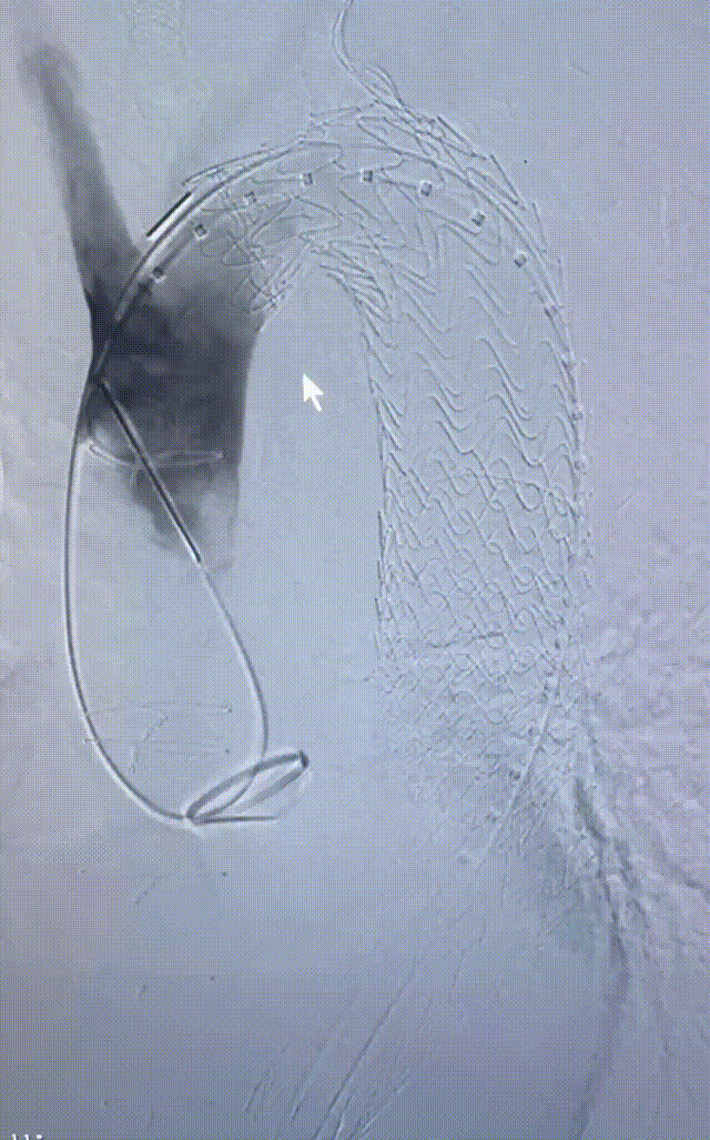 gore医疗怎么样「胸有乾坤」可调可控 精准出击——四川大学华西医院肖正华教授团队：CADS治疗B型主动脉夹层病例分享_https://www.jmylbn.com_新闻资讯_第28张