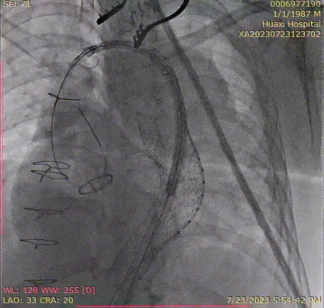 gore医疗怎么样「胸有乾坤」可调可控 精准出击——四川大学华西医院肖正华教授团队：CADS治疗B型主动脉夹层病例分享_https://www.jmylbn.com_新闻资讯_第23张