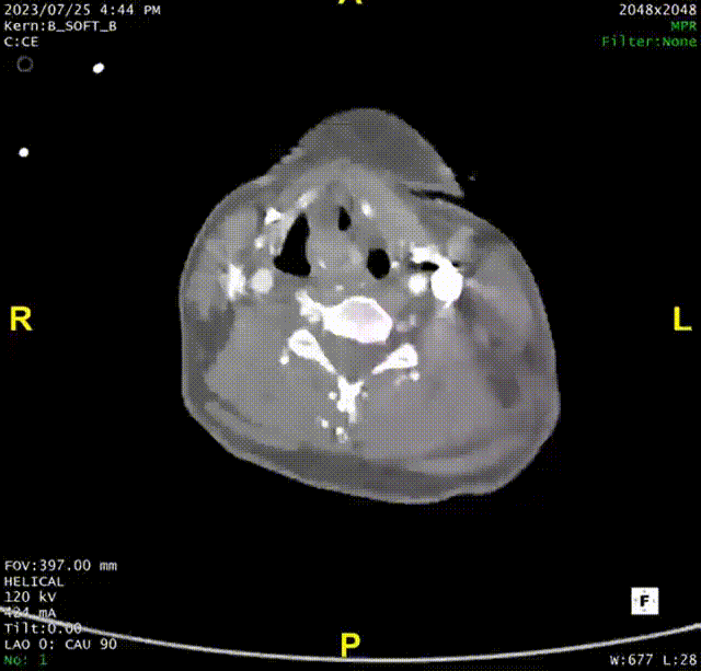 gore医疗怎么样「胸有乾坤」可调可控 精准出击——四川大学华西医院肖正华教授团队：CADS治疗B型主动脉夹层病例分享_https://www.jmylbn.com_新闻资讯_第29张
