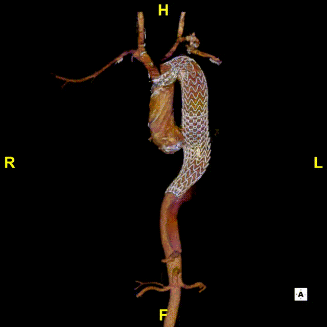 gore医疗怎么样「胸有乾坤」可调可控 精准出击——四川大学华西医院肖正华教授团队：CADS治疗B型主动脉夹层病例分享_https://www.jmylbn.com_新闻资讯_第30张