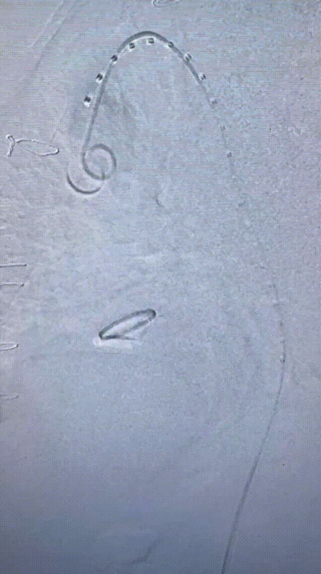 gore医疗怎么样「胸有乾坤」可调可控 精准出击——四川大学华西医院肖正华教授团队：CADS治疗B型主动脉夹层病例分享_https://www.jmylbn.com_新闻资讯_第20张