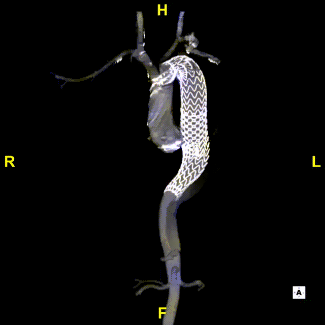 gore医疗怎么样「胸有乾坤」可调可控 精准出击——四川大学华西医院肖正华教授团队：CADS治疗B型主动脉夹层病例分享_https://www.jmylbn.com_新闻资讯_第31张