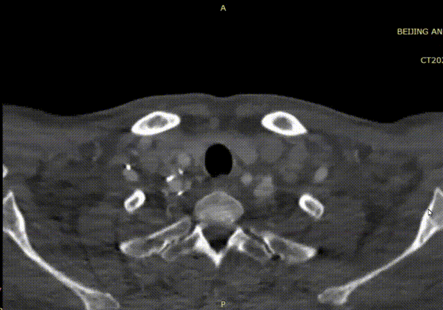 波科支架怎么样波科@CEC2025｜TCAR新技术手术交流会精彩荟萃_https://www.jmylbn.com_新闻资讯_第9张