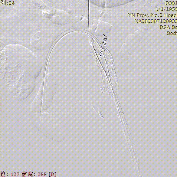 gore医疗怎么样「漫腹精论」双股动脉入路，纯腔内保双髂——GORE® EXCLUDER® 髂动脉分支型覆膜支架（IBE）治疗双侧髂总动脉_https://www.jmylbn.com_新闻资讯_第17张