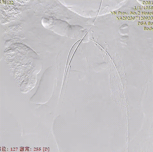 gore医疗怎么样「漫腹精论」双股动脉入路，纯腔内保双髂——GORE® EXCLUDER® 髂动脉分支型覆膜支架（IBE）治疗双侧髂总动脉_https://www.jmylbn.com_新闻资讯_第21张