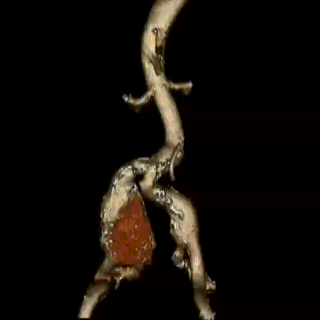 gore医疗怎么样「漫腹精论」双股动脉入路，纯腔内保双髂——GORE® EXCLUDER® 髂动脉分支型覆膜支架（IBE）治疗双侧髂总动脉_https://www.jmylbn.com_新闻资讯_第6张