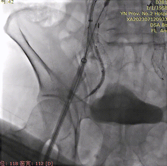 gore医疗怎么样「漫腹精论」双股动脉入路，纯腔内保双髂——GORE® EXCLUDER® 髂动脉分支型覆膜支架（IBE）治疗双侧髂总动脉_https://www.jmylbn.com_新闻资讯_第26张