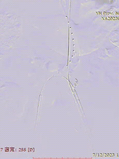 gore医疗怎么样「漫腹精论」双股动脉入路，纯腔内保双髂——GORE® EXCLUDER® 髂动脉分支型覆膜支架（IBE）治疗双侧髂总动脉_https://www.jmylbn.com_新闻资讯_第13张