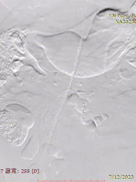 gore医疗怎么样「漫腹精论」双股动脉入路，纯腔内保双髂——GORE® EXCLUDER® 髂动脉分支型覆膜支架（IBE）治疗双侧髂总动脉_https://www.jmylbn.com_新闻资讯_第30张