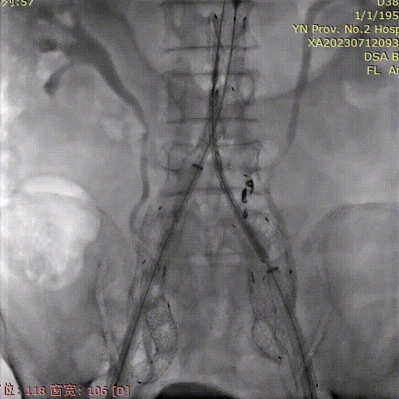 gore医疗怎么样「漫腹精论」双股动脉入路，纯腔内保双髂——GORE® EXCLUDER® 髂动脉分支型覆膜支架（IBE）治疗双侧髂总动脉_https://www.jmylbn.com_新闻资讯_第32张