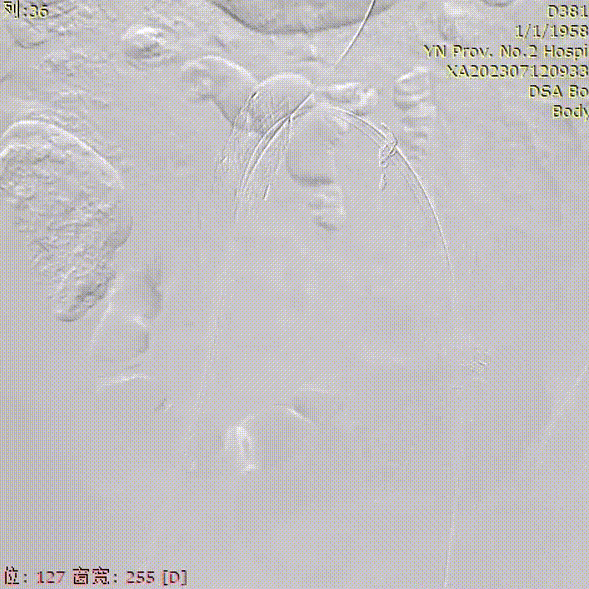 gore医疗怎么样「漫腹精论」双股动脉入路，纯腔内保双髂——GORE® EXCLUDER® 髂动脉分支型覆膜支架（IBE）治疗双侧髂总动脉_https://www.jmylbn.com_新闻资讯_第23张