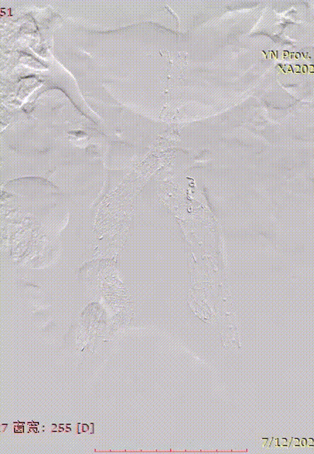 gore医疗怎么样「漫腹精论」双股动脉入路，纯腔内保双髂——GORE® EXCLUDER® 髂动脉分支型覆膜支架（IBE）治疗双侧髂总动脉_https://www.jmylbn.com_新闻资讯_第37张