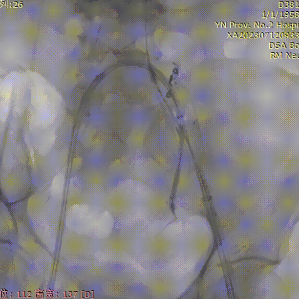 gore医疗怎么样「漫腹精论」双股动脉入路，纯腔内保双髂——GORE® EXCLUDER® 髂动脉分支型覆膜支架（IBE）治疗双侧髂总动脉_https://www.jmylbn.com_新闻资讯_第18张