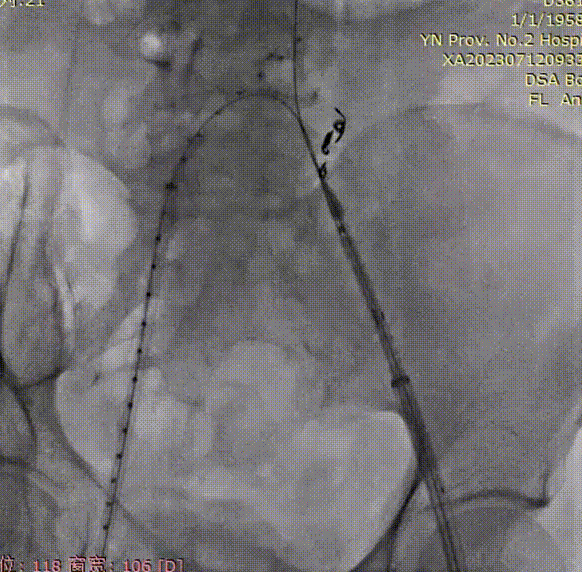 gore医疗怎么样「漫腹精论」双股动脉入路，纯腔内保双髂——GORE® EXCLUDER® 髂动脉分支型覆膜支架（IBE）治疗双侧髂总动脉_https://www.jmylbn.com_新闻资讯_第14张
