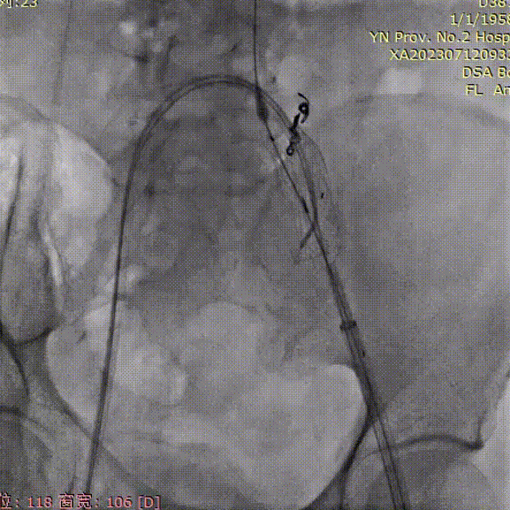 gore医疗怎么样「漫腹精论」双股动脉入路，纯腔内保双髂——GORE® EXCLUDER® 髂动脉分支型覆膜支架（IBE）治疗双侧髂总动脉_https://www.jmylbn.com_新闻资讯_第16张